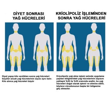 Quartus Cryolipolys Soğuk Lipoliz Zayıflama Cihazı
